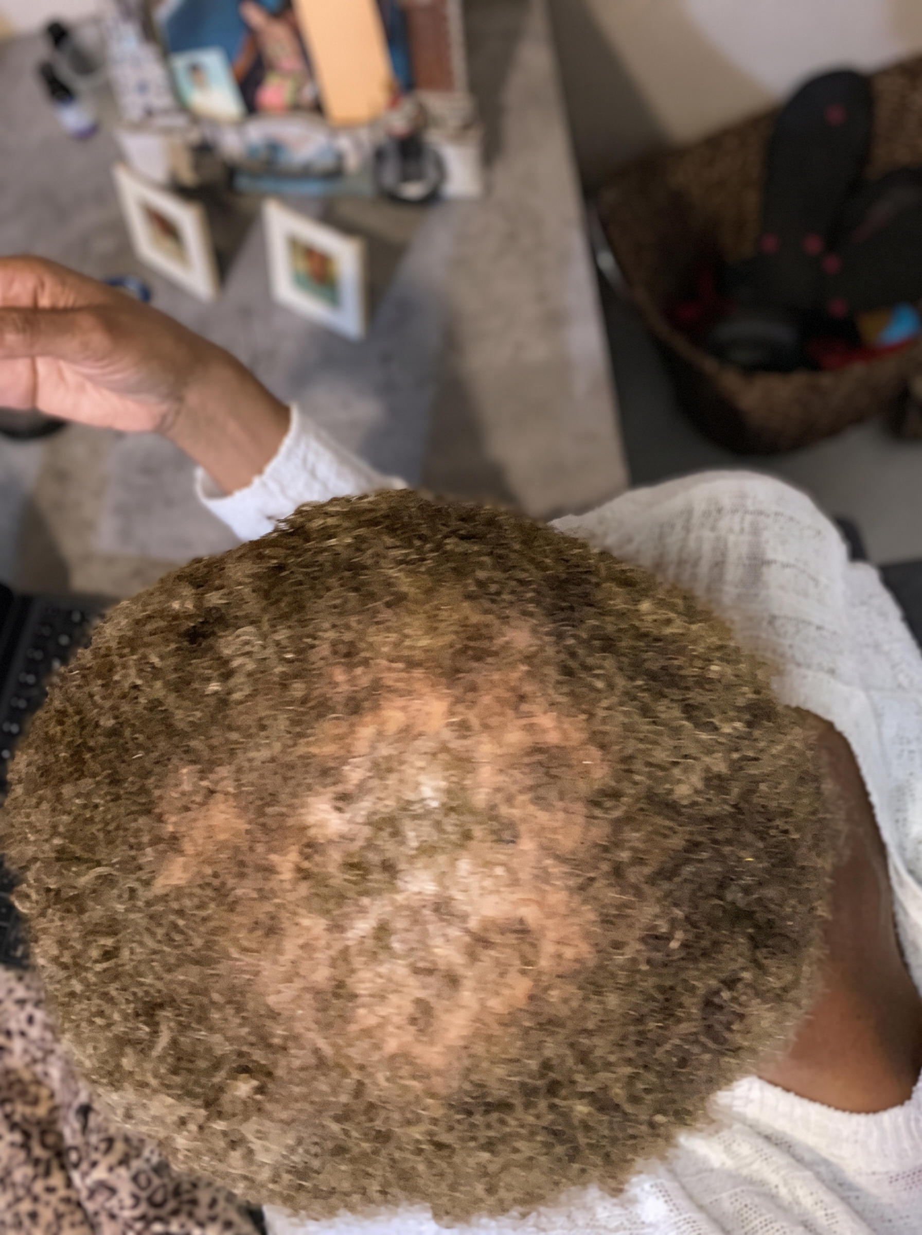 Anjanette's scalp showing regrown hair